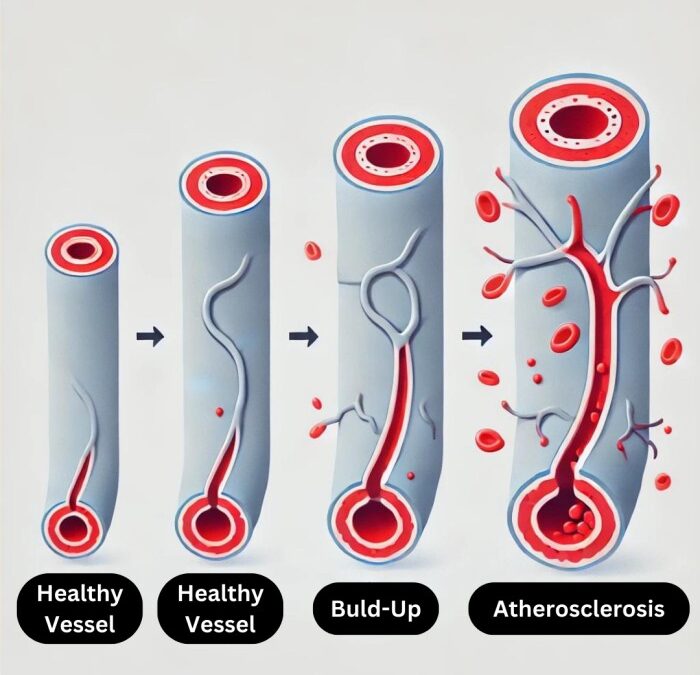 Patogenia de la Aterosclerosis